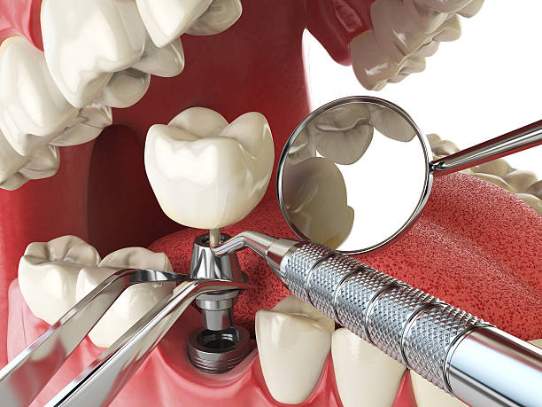 Best Emergency Root Canal Treatment in Colonial Heights, TN